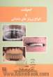 ایمپلنت و انواع پروتزهای دندانی